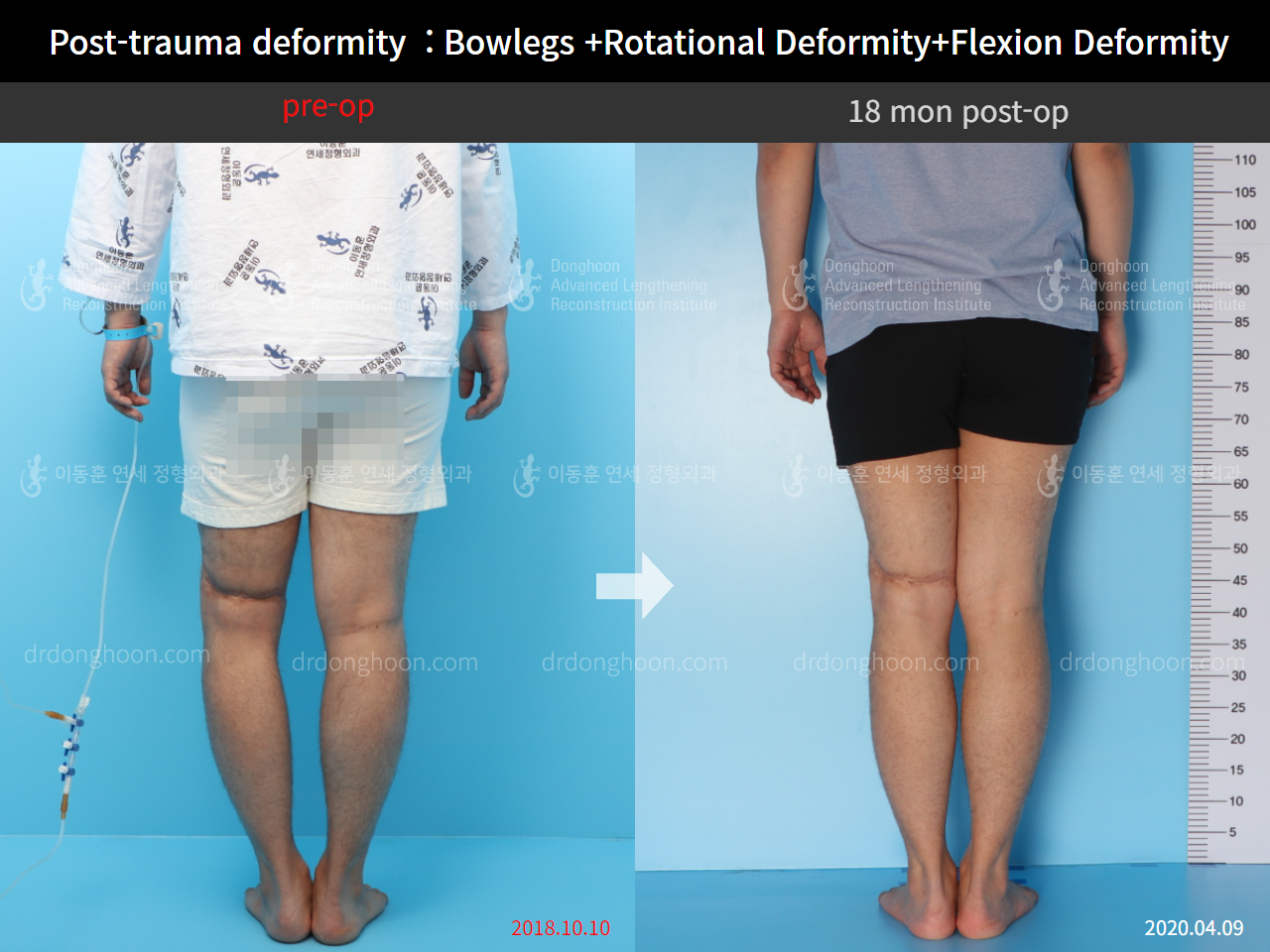 Before and after post-trauma deformity, case 4595393, image 3, Dr. Donghoon institute (DALRI)