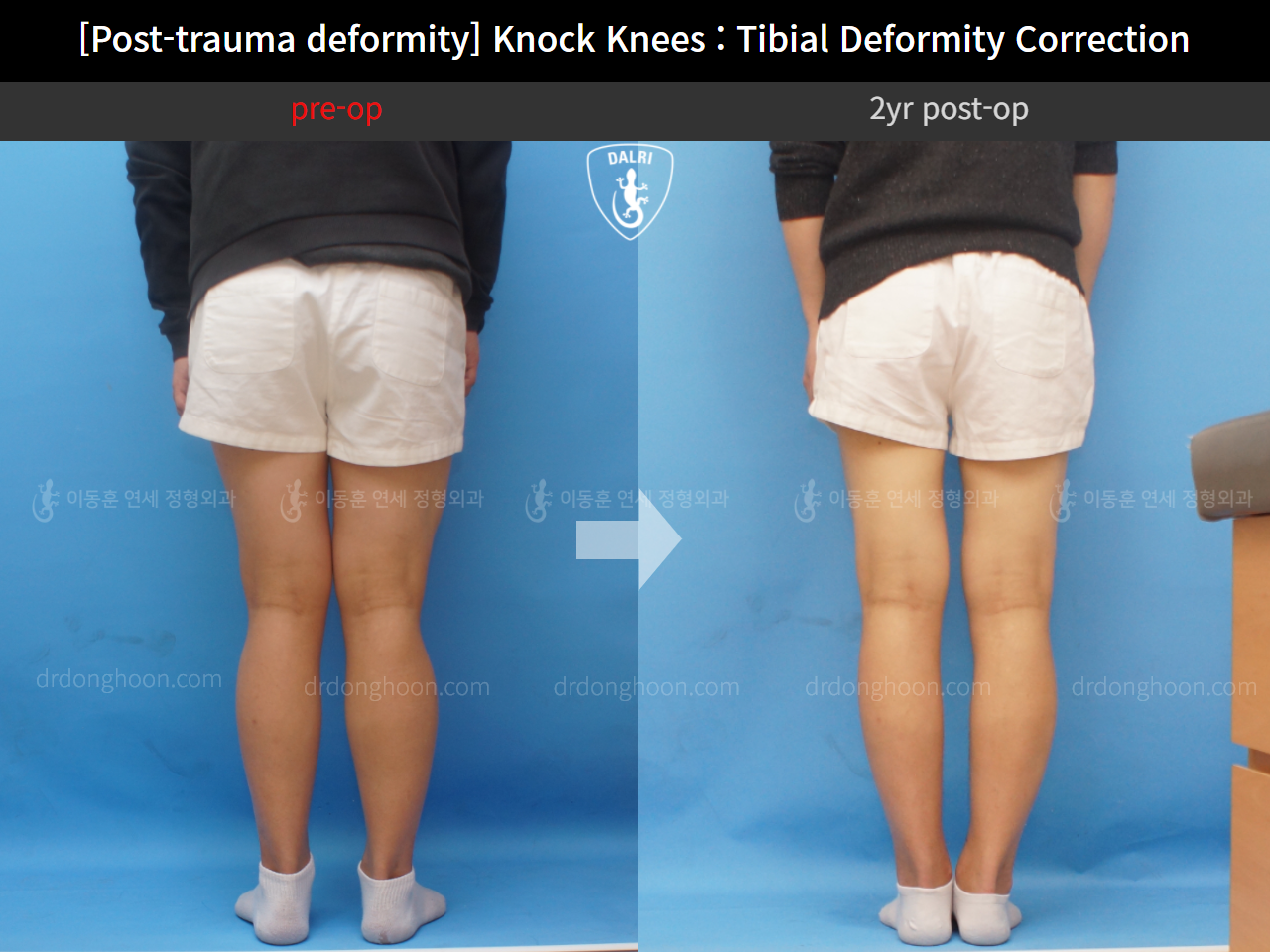 Before and after post-trauma deformity, case 9758216, image 2, Dr. Donghoon institute (DALRI)