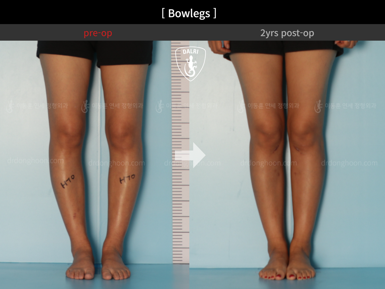 Before and after adult bowlegs, case 12060396, image 5, Dr. Donghoon institute (DALRI)