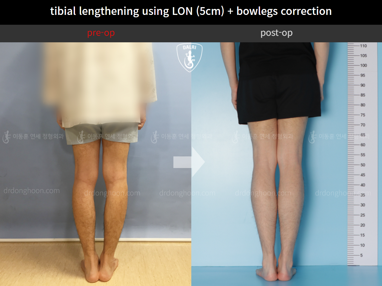 Before and after cll + deformity correction, case 4323130, image 6, Dr. Donghoon institute (DALRI)