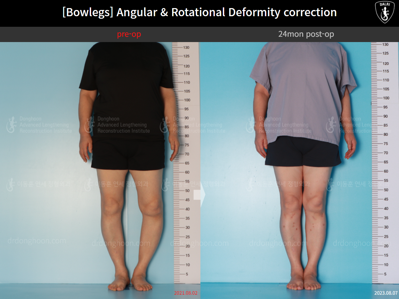 Before and after osteotomy for knee osteoarthritis, case 16074487, image 3, Dr. Donghoon institute (DALRI)