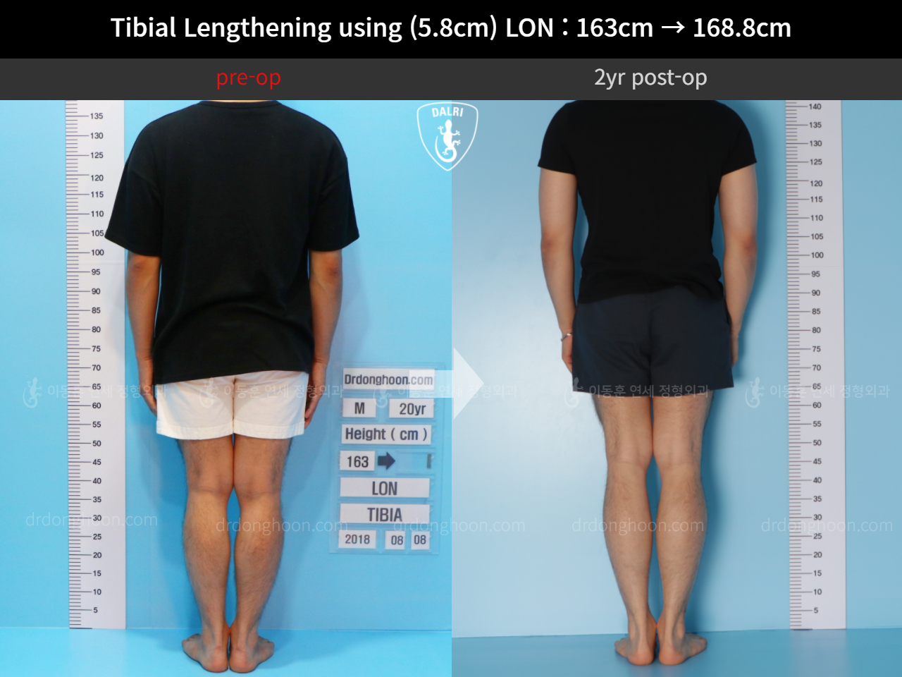 Before and after cll lon, case 11468172, image 2, Dr. Donghoon institute (DALRI)
