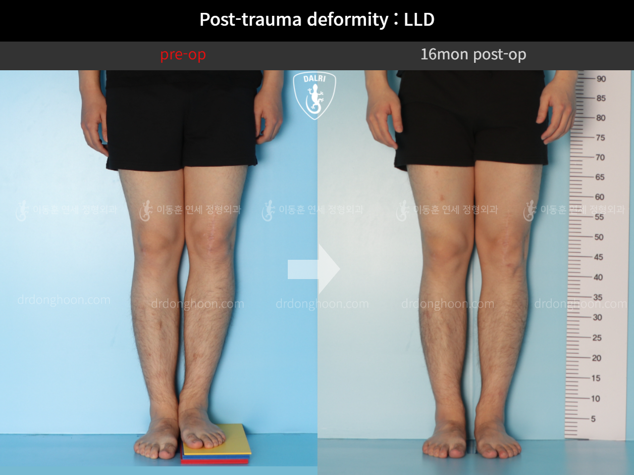 Before and after adult lld, case 11086886, image 4, Dr. Donghoon institute (DALRI)