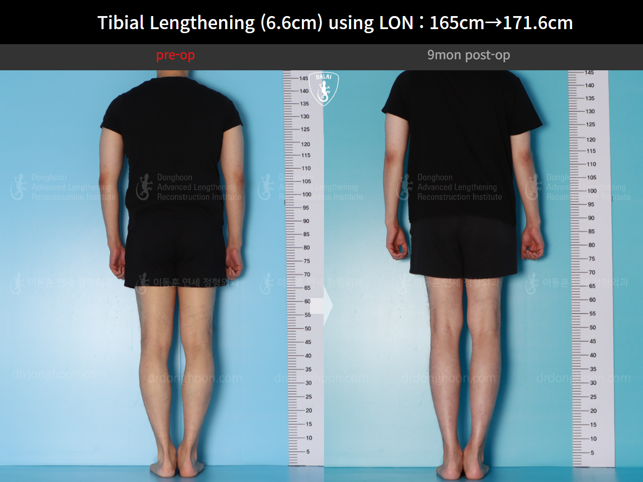 Before and after cll lon, case 16780660, image 3, Dr. Donghoon institute (DALRI)
