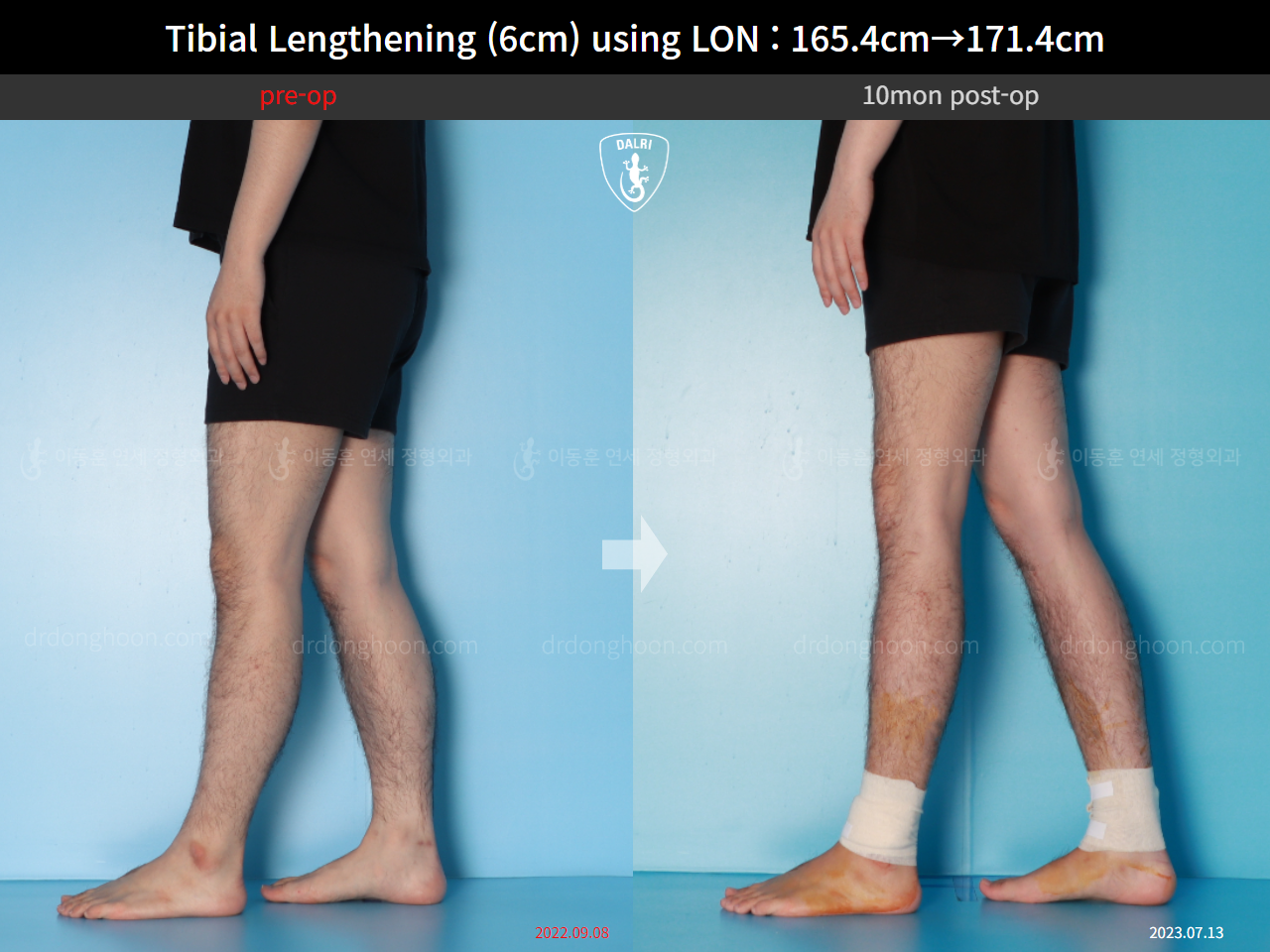 Before and after cll lon, case 15716525, image 11, Dr. Donghoon institute (DALRI)