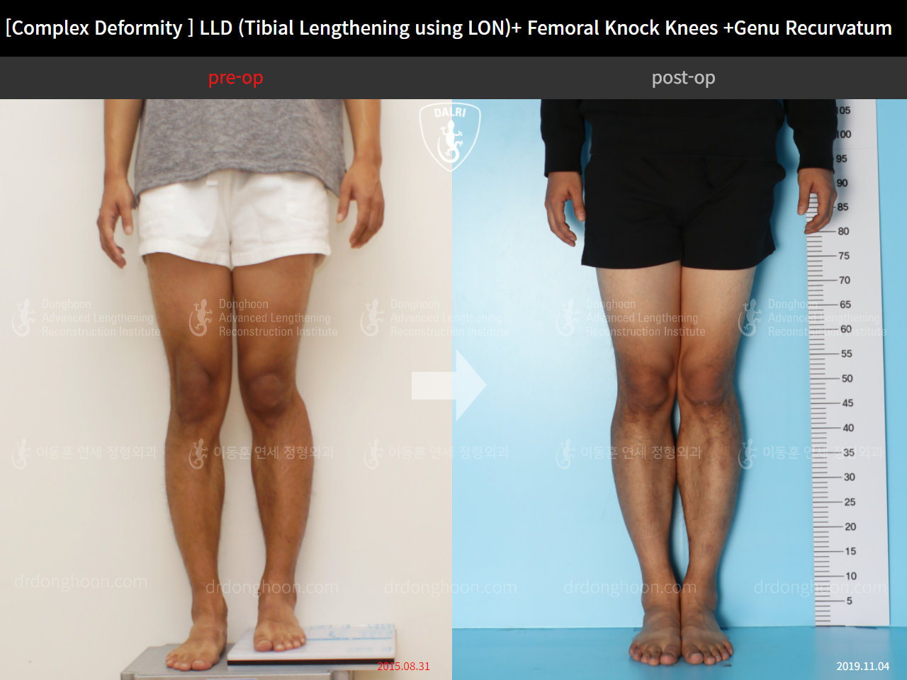 Before and after complex deformity, case 9263548, image 4, Dr. Donghoon institute (DALRI)