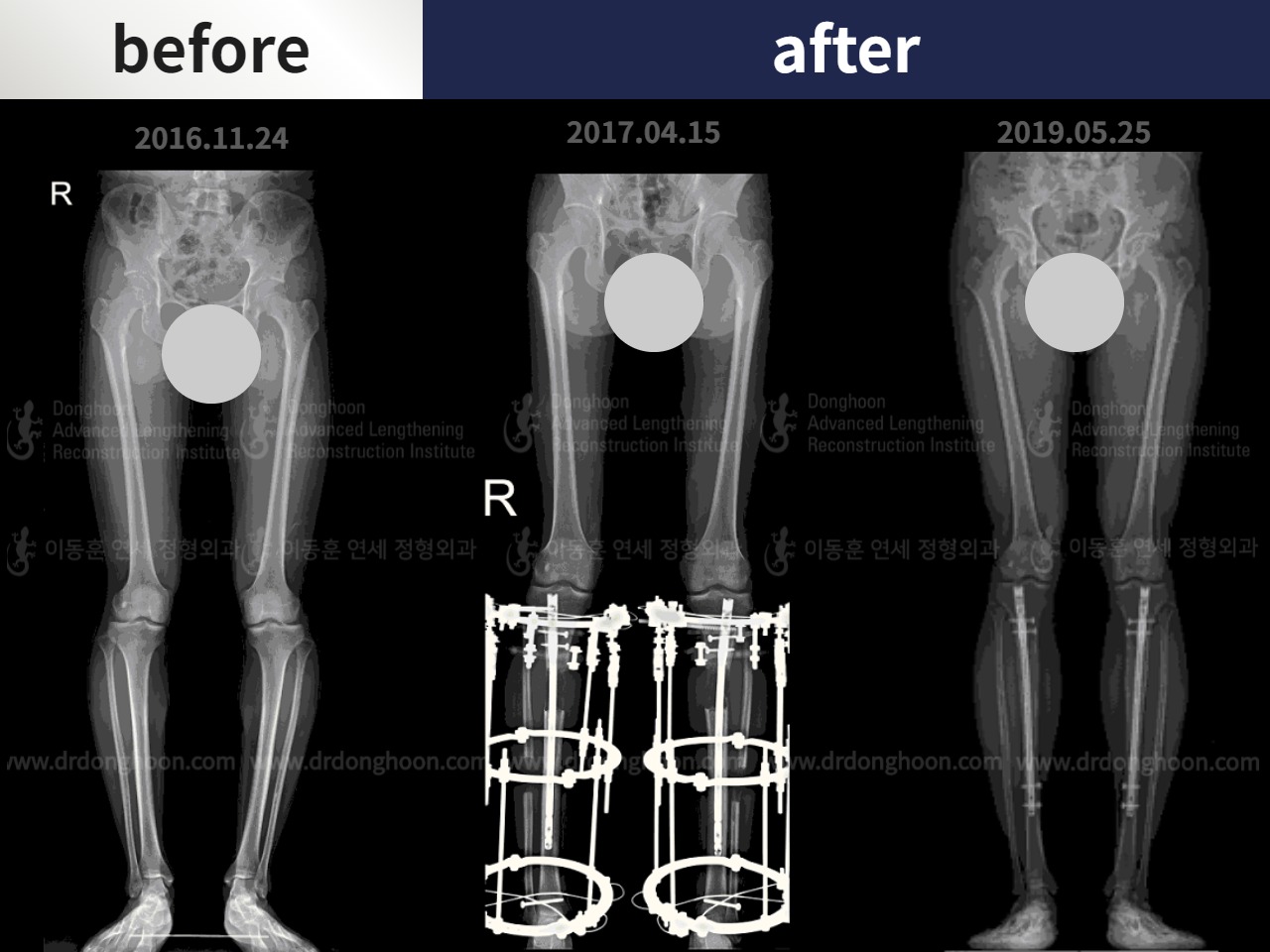 Before and after cll + deformity correction, case 4585657, image 3, Dr. Donghoon institute (DALRI)