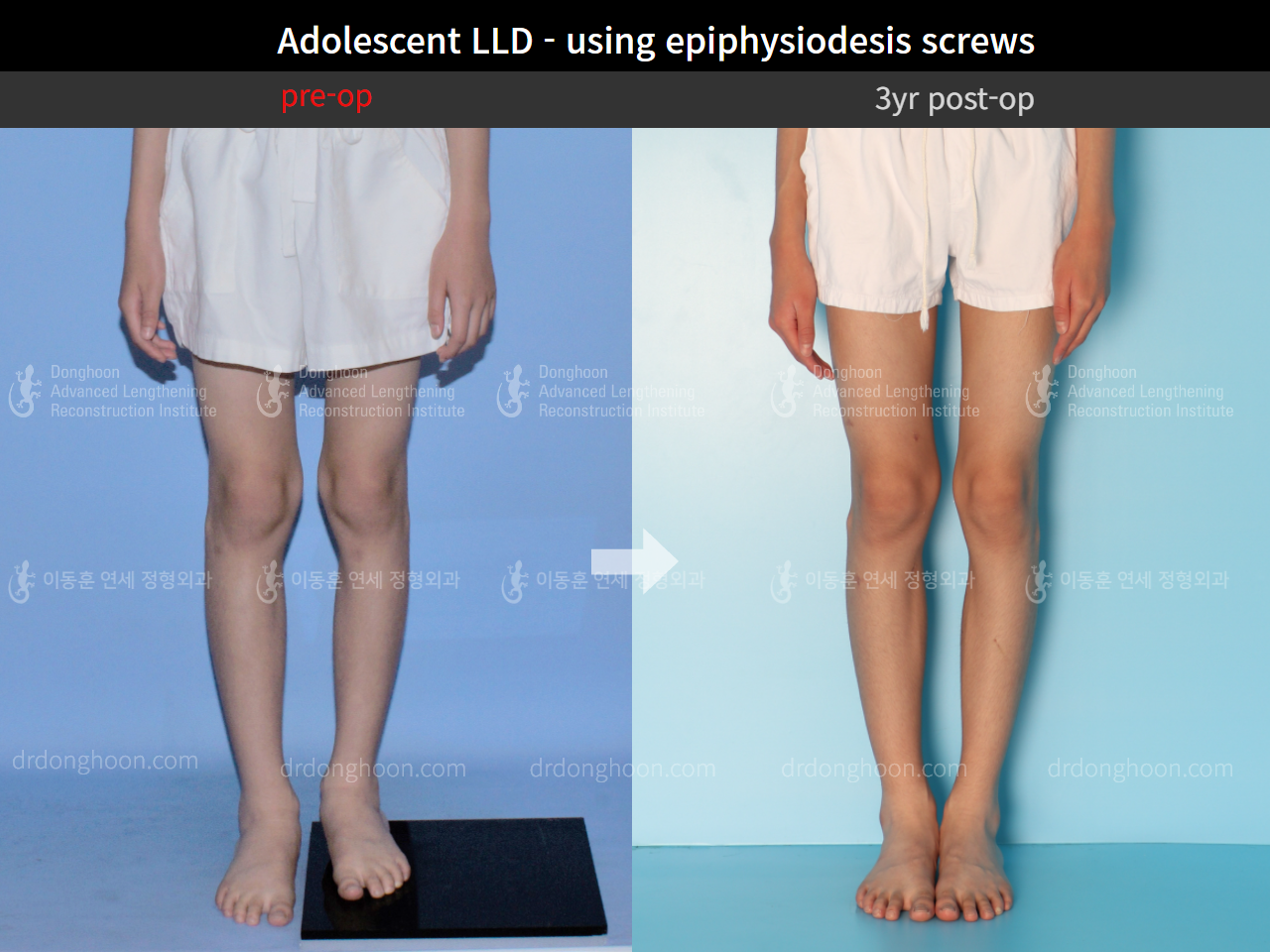 Before and after paediatric & adolescent lld, case 4320386, image 3, Dr. Donghoon institute (DALRI)