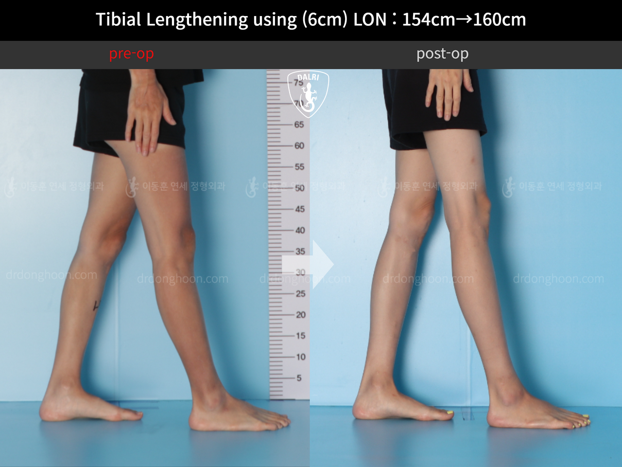 Before and after cll lon, case 12786266, image 7, Dr. Donghoon institute (DALRI)