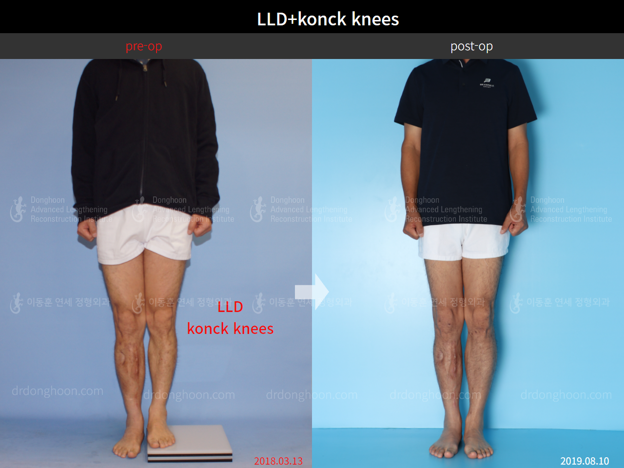 Before and after adult lld, case 8815381, image 3, Dr. Donghoon institute (DALRI)