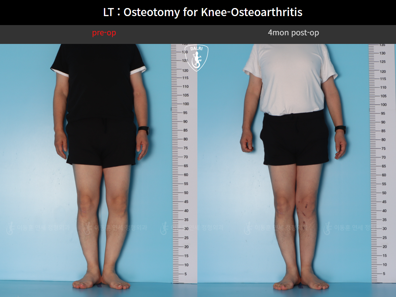 Before and after osteotomy for knee osteoarthritis, case 128374850, image 2, Dr. Donghoon institute (DALRI)