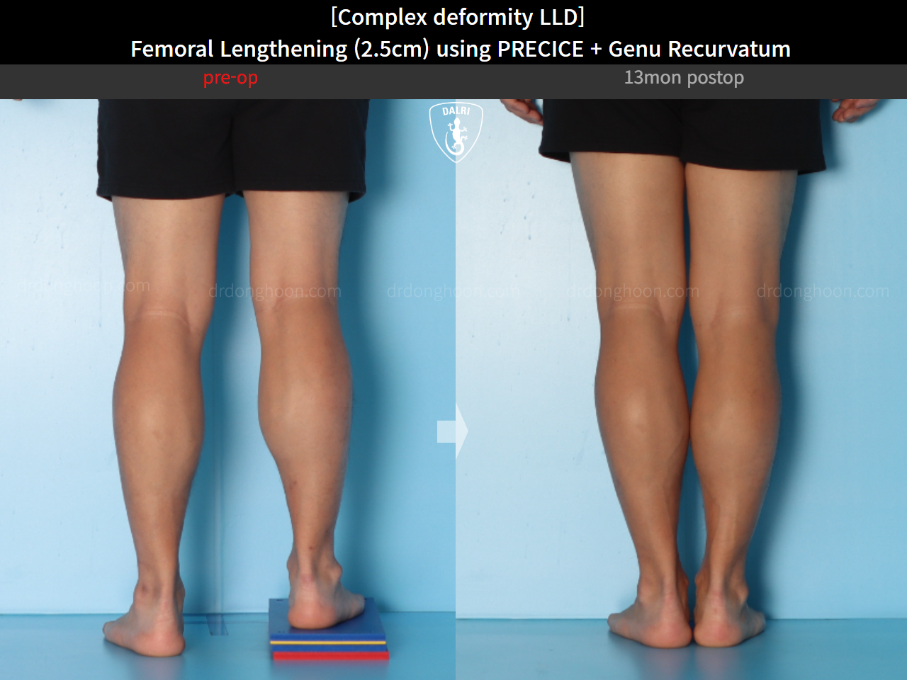 Before and after genu recurvatum, case 16854701, image 8, Dr. Donghoon institute (DALRI)