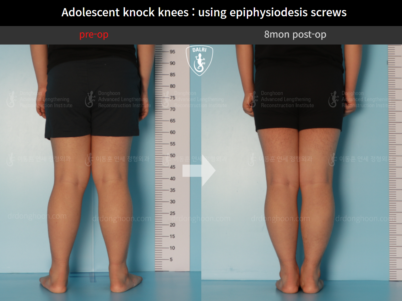Before and after paediatric & adolescent knock knees, case 9743785, image 4, Dr. Donghoon institute (DALRI)