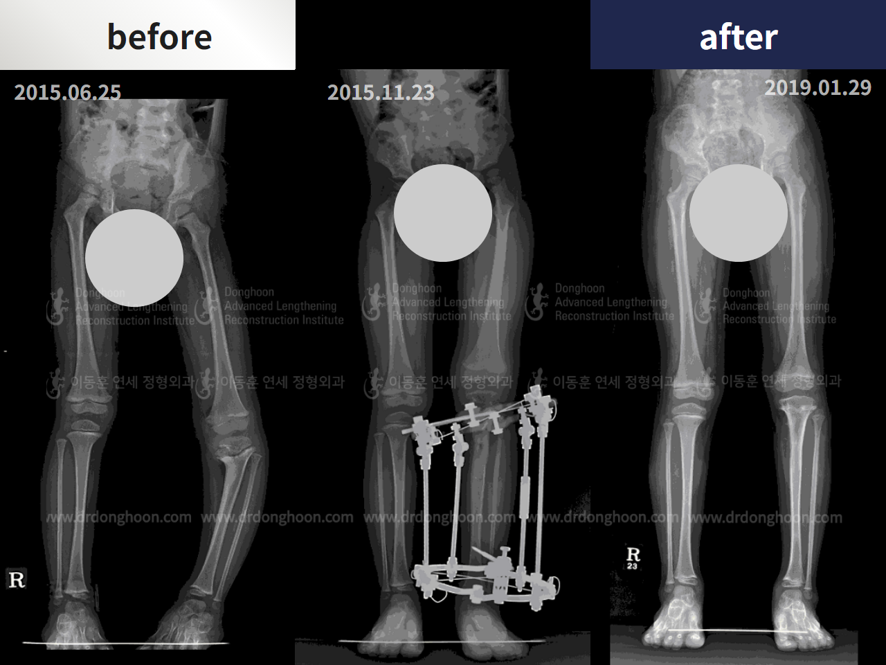 Before and after paediatric congenital condition, case 4304793, image 3, Dr. Donghoon institute (DALRI)