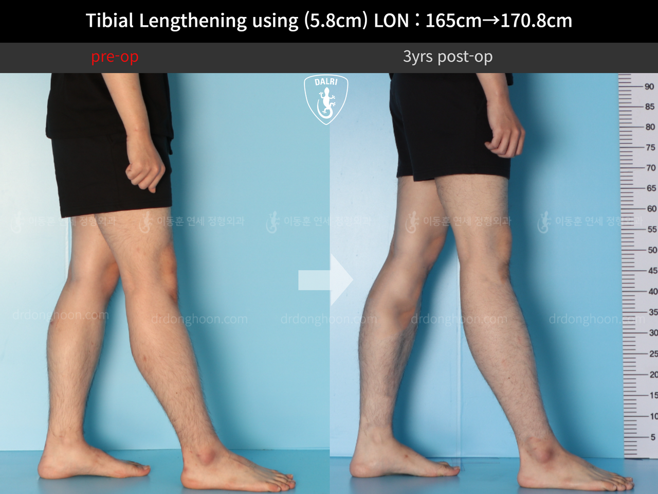 Before and after cll lon, case 12828098, image 7, Dr. Donghoon institute (DALRI)