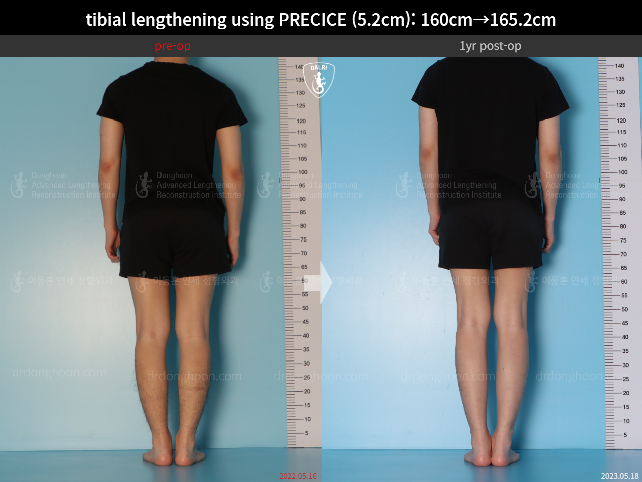 Before and after cll precice, case 15213098, image 3, Dr. Donghoon institute (DALRI)