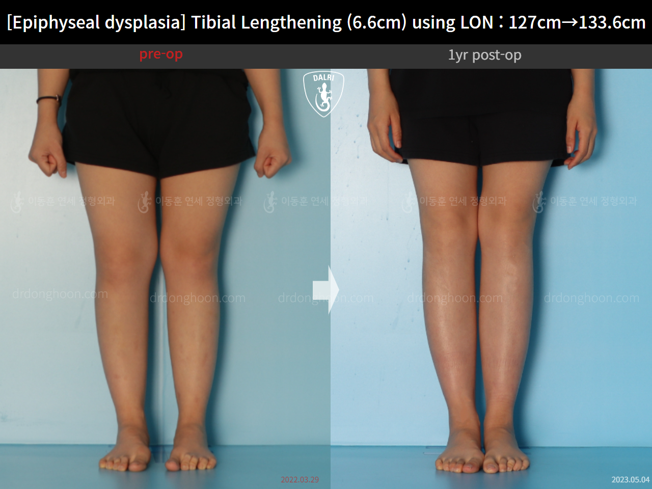 Before and after congenital condition, case 15072062, image 7, Dr. Donghoon institute (DALRI)