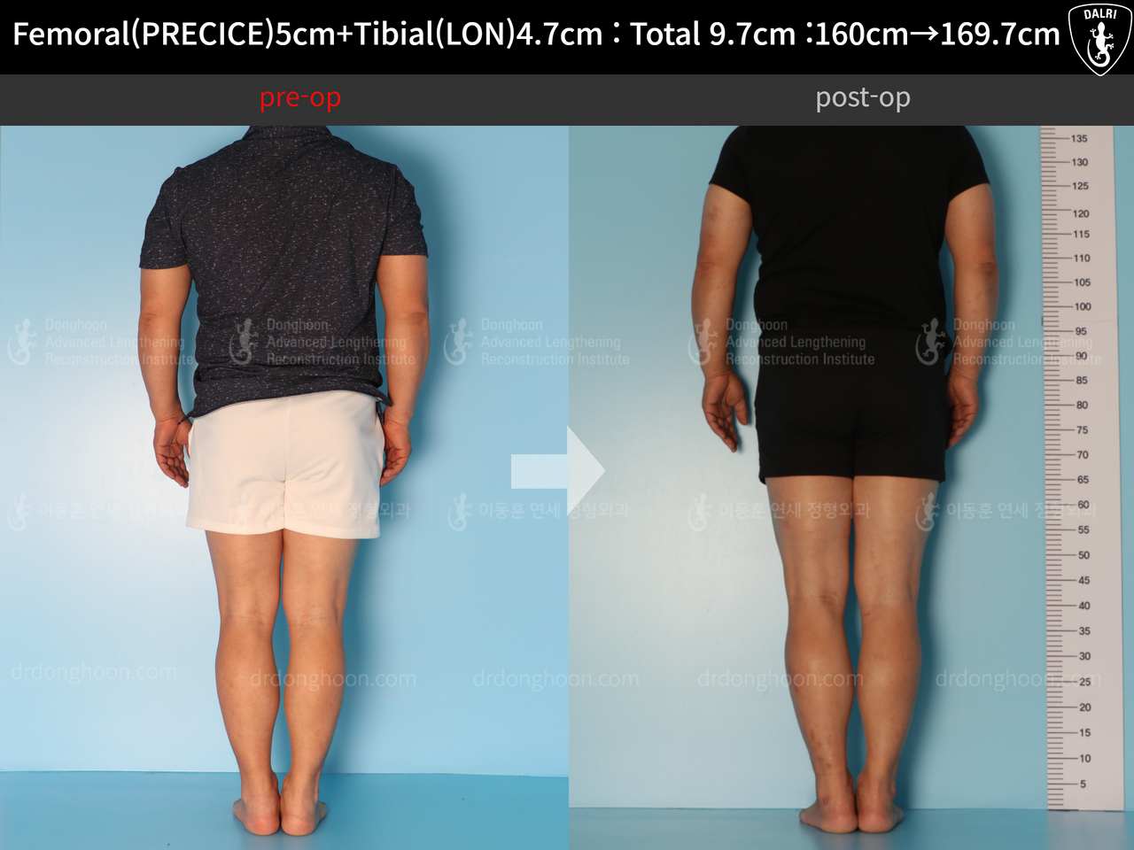 Before and after cll precice, case 7755066, image 4, Dr. Donghoon institute (DALRI)
