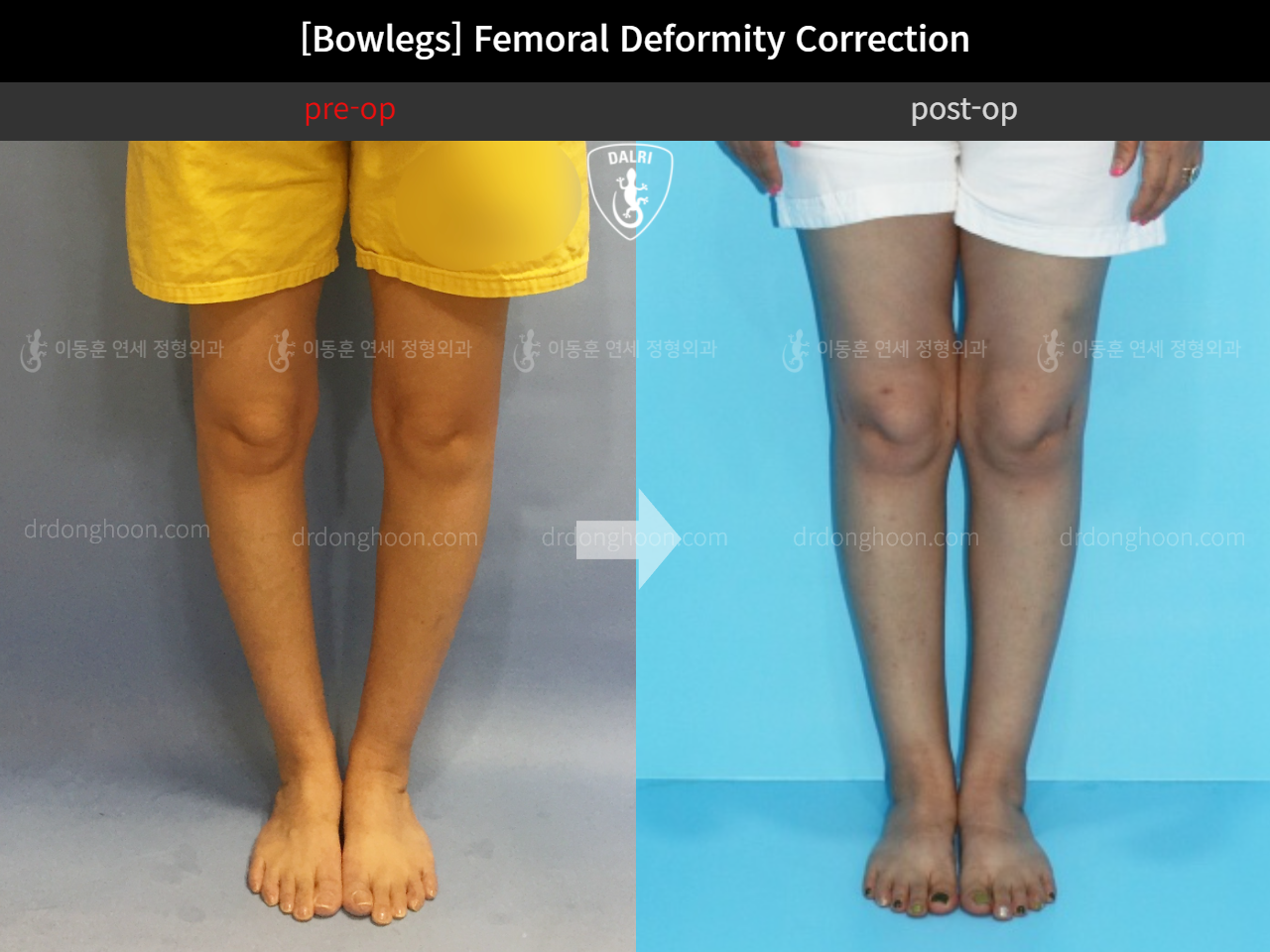 Before and after adult bowlegs, case 11379035, image 4, Dr. Donghoon institute (DALRI)