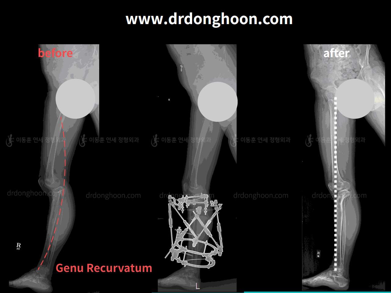 Before and after complex deformity, case 4251572, image 3, Dr. Donghoon institute (DALRI)