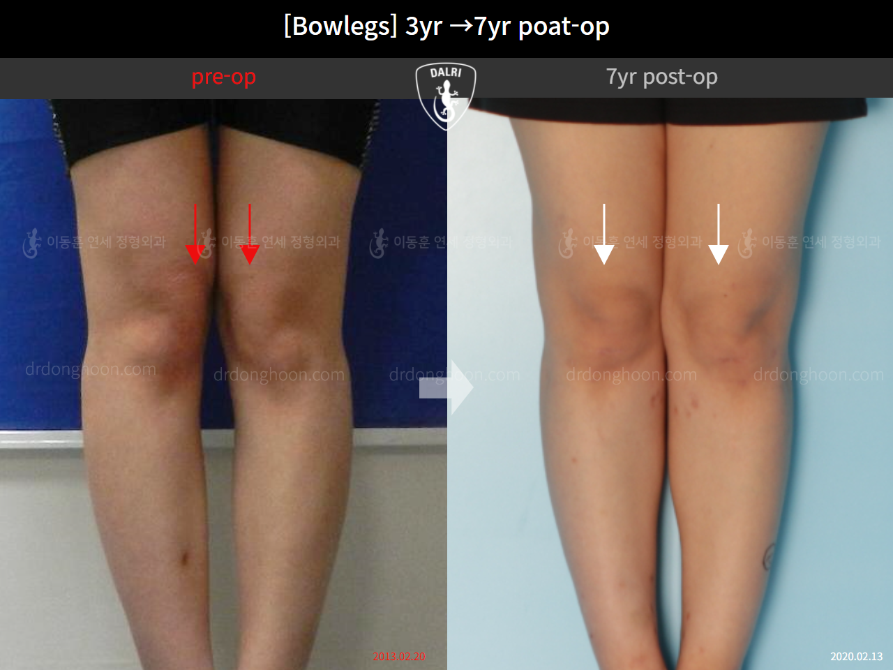 Before and after adult bowlegs, case 10516860, image 3, Dr. Donghoon institute (DALRI)