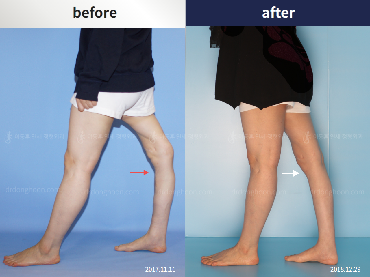 Before and after genu recurvatum, case 4250826, image 2, Dr. Donghoon institute (DALRI)