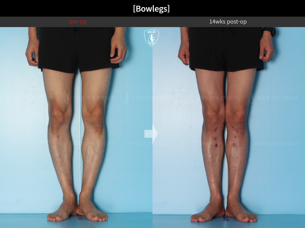 Before and after adult bowlegs, case 15512423, image 8, Dr. Donghoon institute (DALRI)