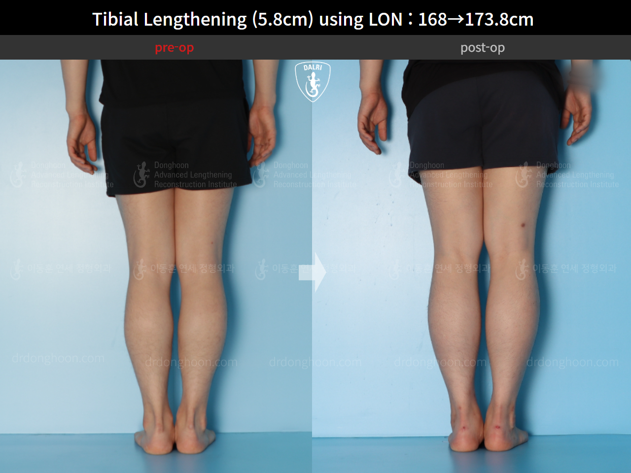 Before and after cll lon, case 15625788, image 6, Dr. Donghoon institute (DALRI)