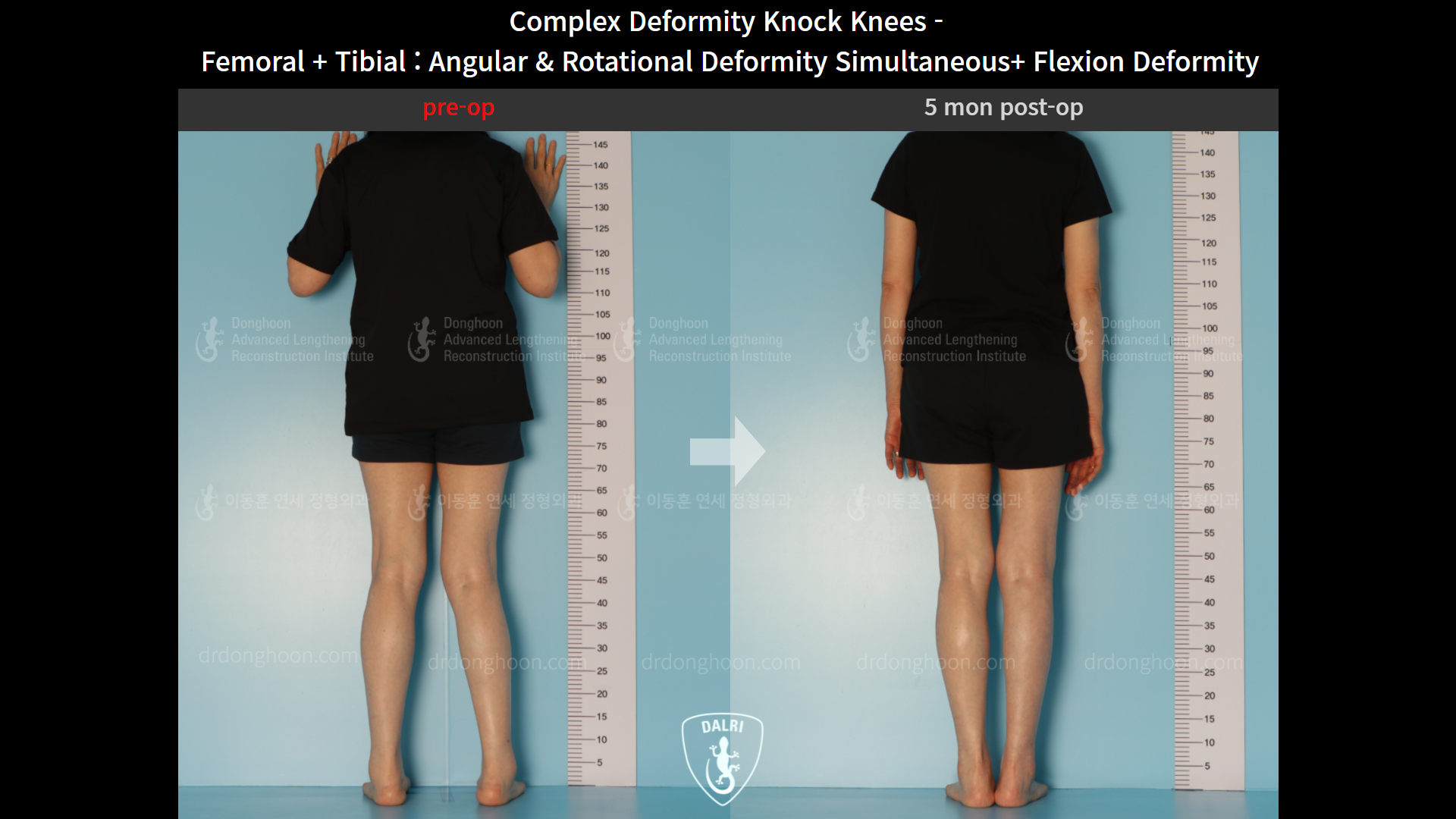 Before and after adult knock knees, case 9153798, image 2, Dr. Donghoon institute (DALRI)