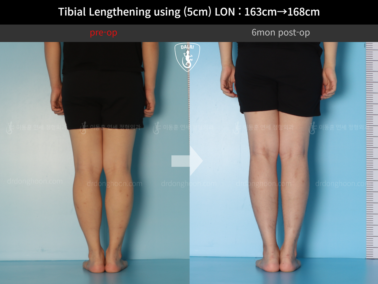 Before and after cll lon, case 12638628, image 5, Dr. Donghoon institute (DALRI)