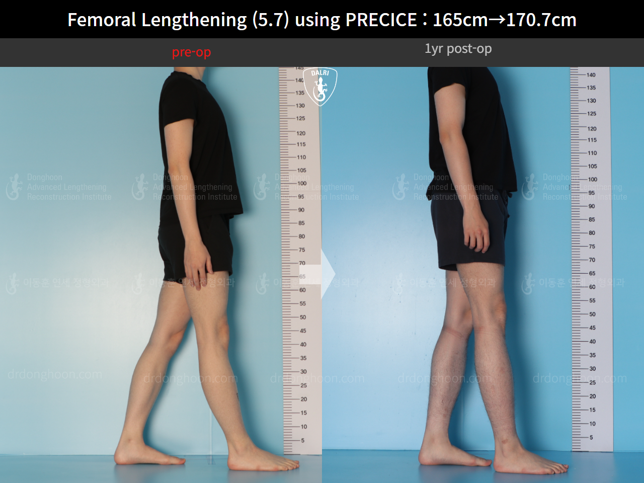 Before and after cll precice, case 15417090, image 3, Dr. Donghoon institute (DALRI)