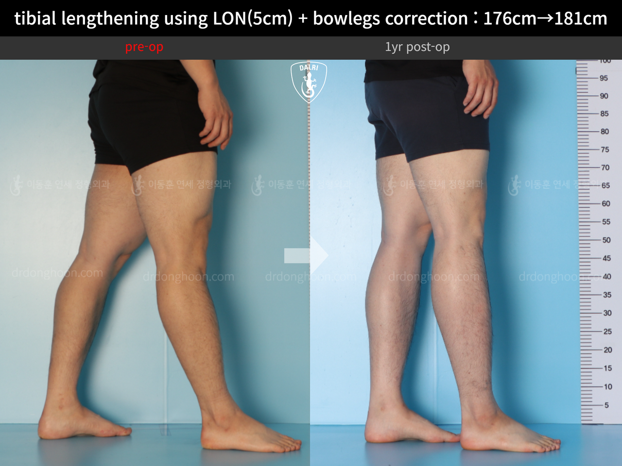 Before and after cll + deformity correction, case 13410849, image 10, Dr. Donghoon institute (DALRI)