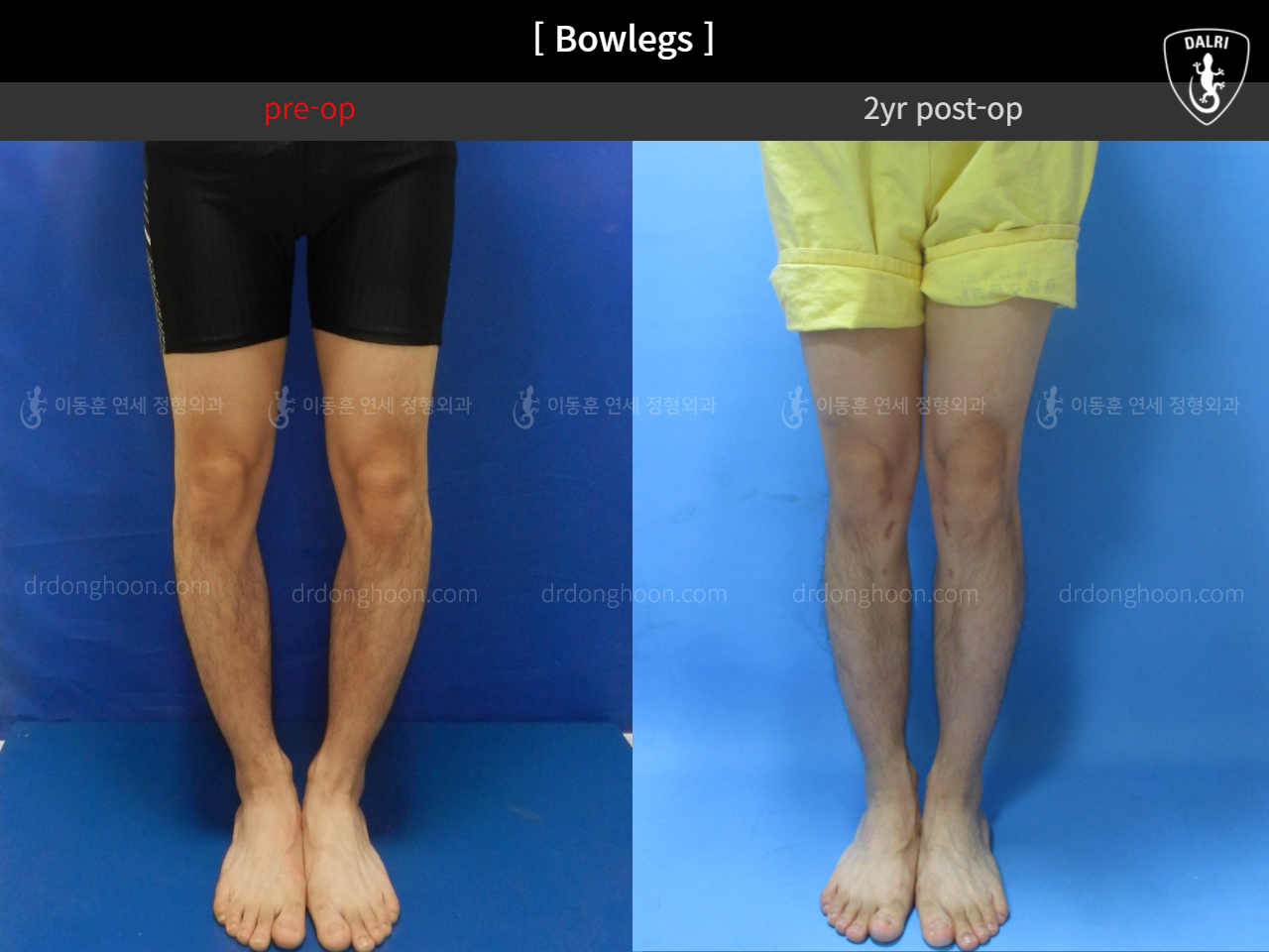 Before and after adult bowlegs, case 4311104, image 2, Dr. Donghoon institute (DALRI)