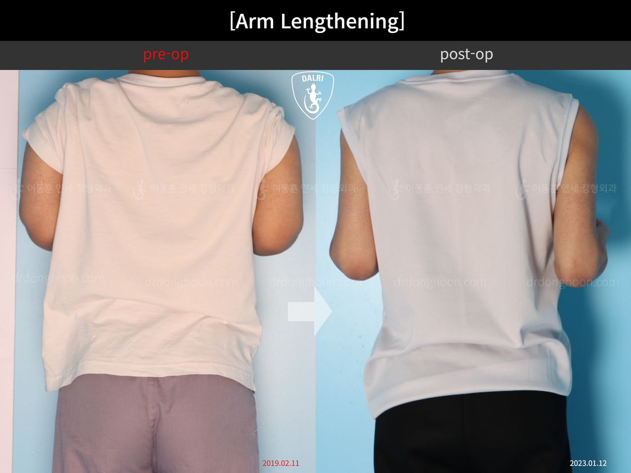 Before and after arm lengthening, case 13957846, image 2, Dr. Donghoon institute (DALRI)