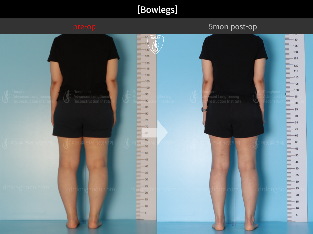 Before and after adult bowlegs, case 13212059, image 6, Dr. Donghoon institute (DALRI)