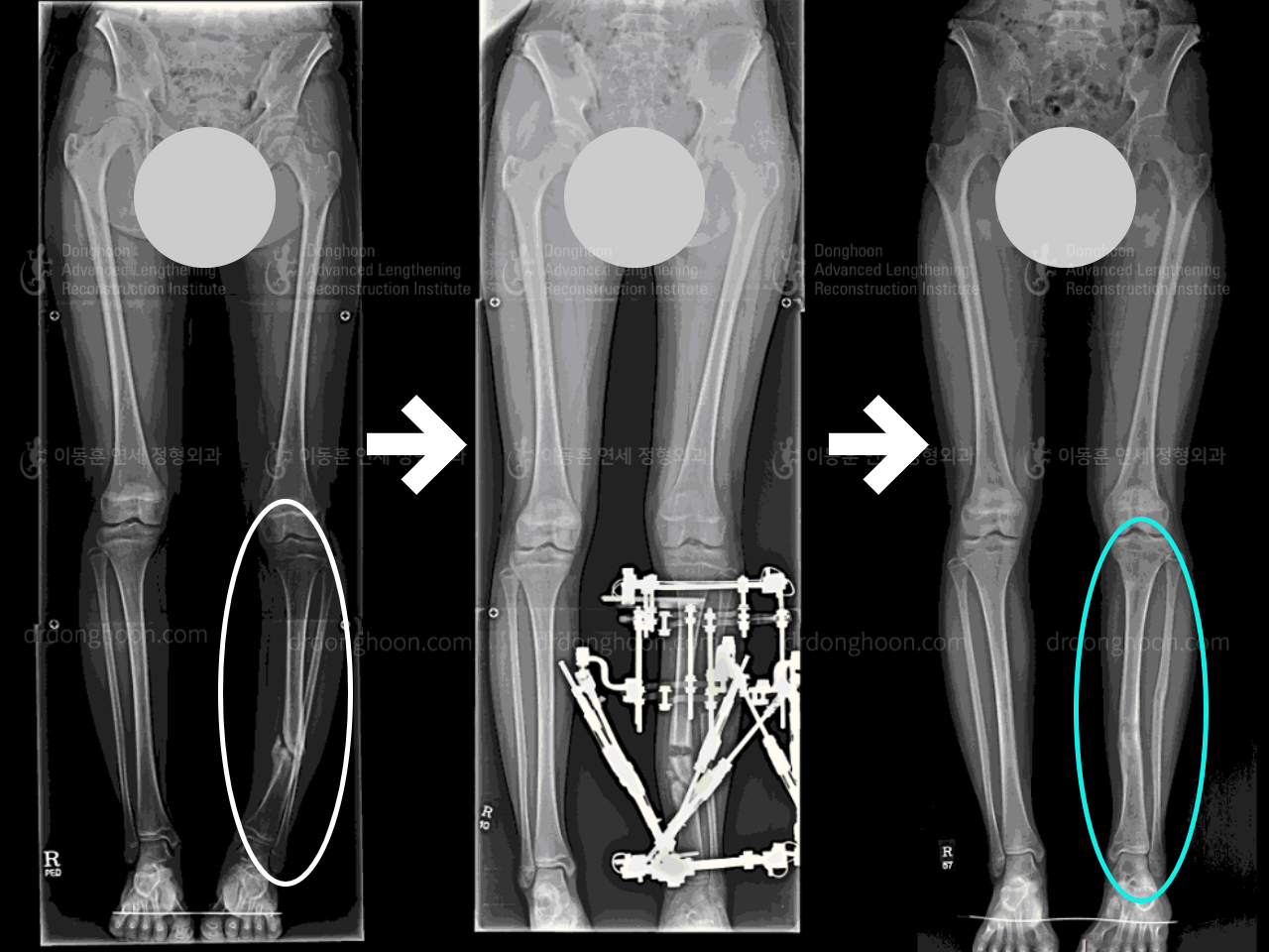 Before and after post-trauma deformity, case 4355008, image 2, Dr. Donghoon institute (DALRI)
