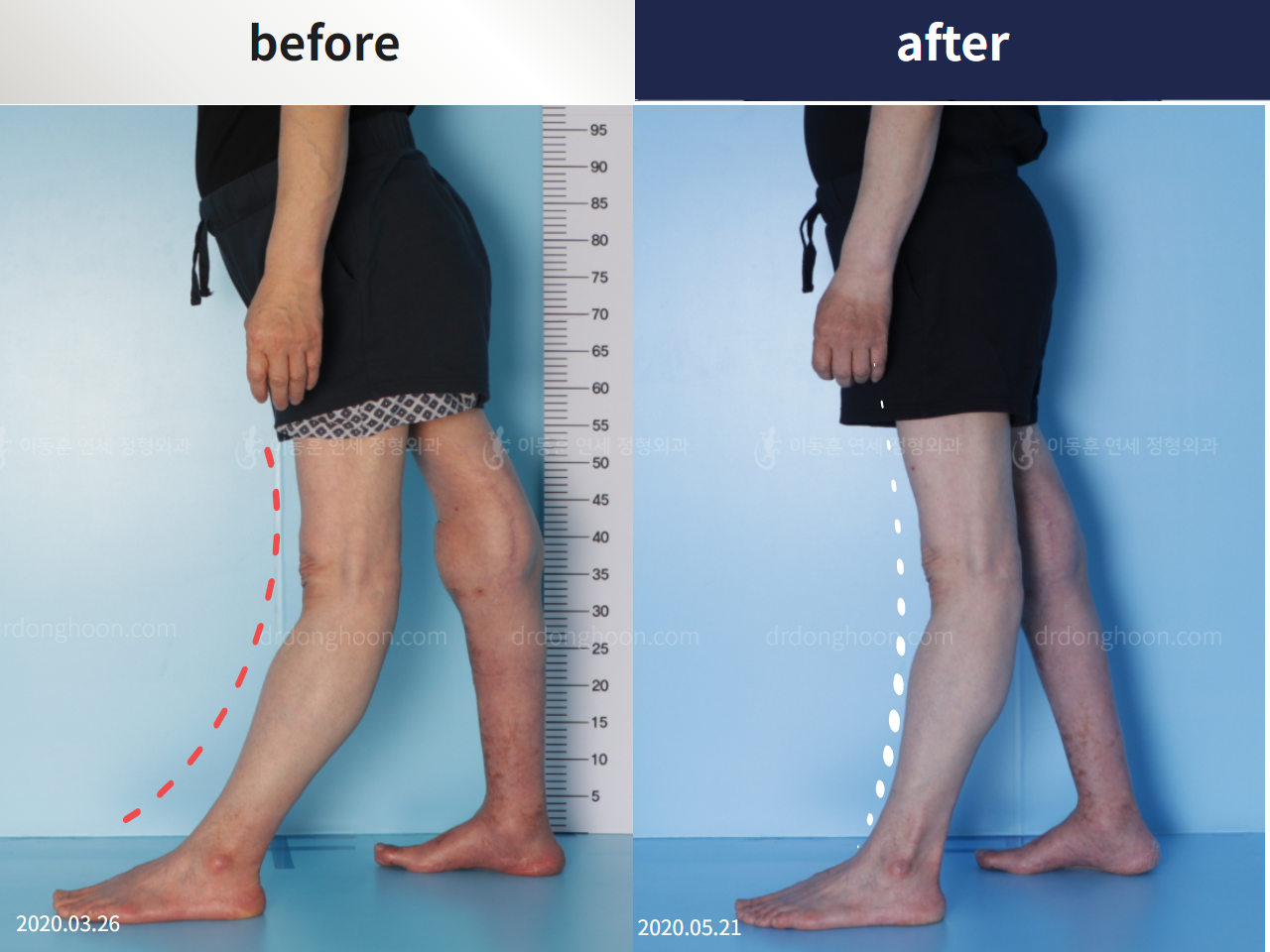 Before and after congenital condition, case 4304680, image 5, Dr. Donghoon institute (DALRI)