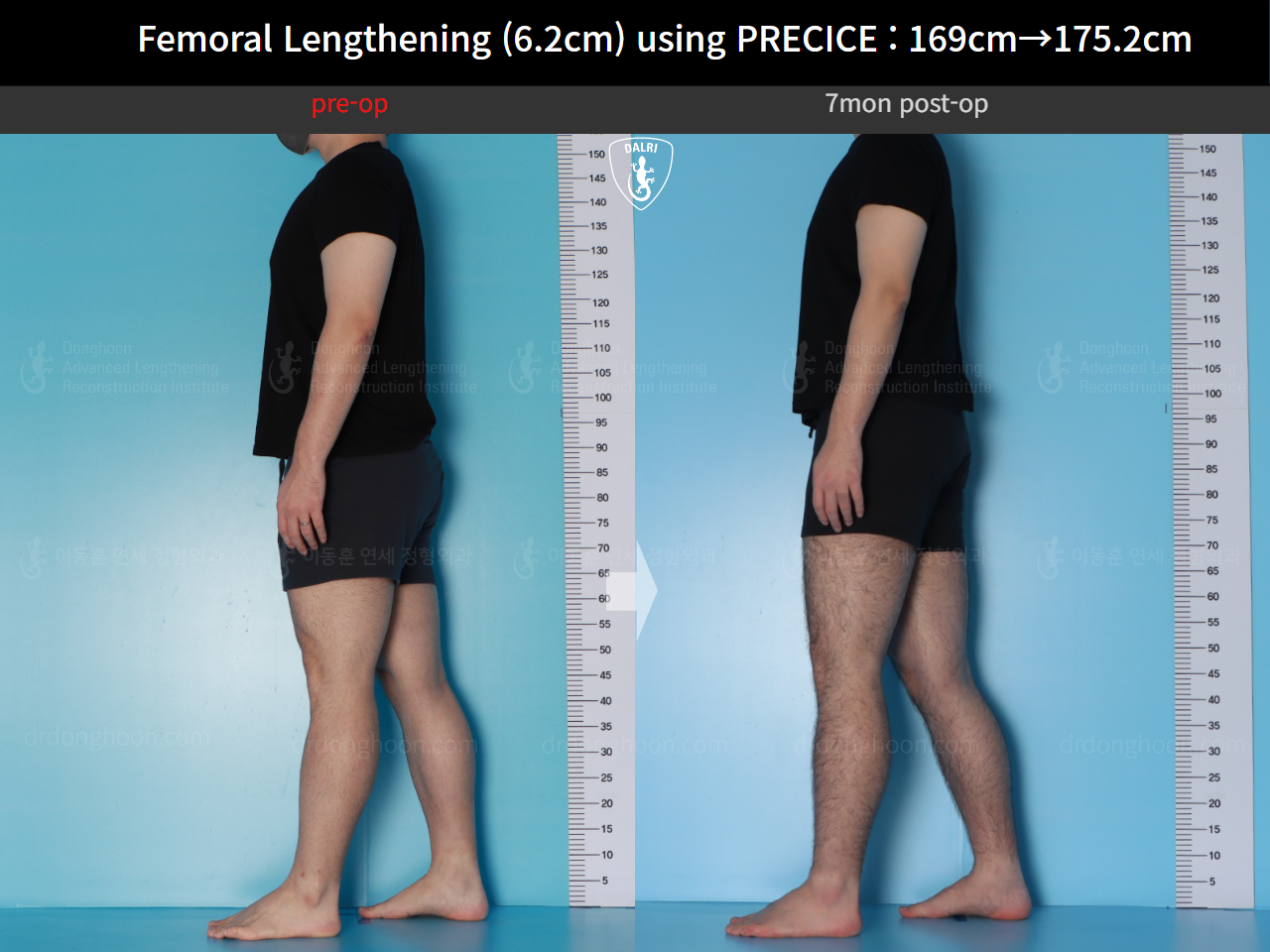 Before and after cll precice, case 20671201, image 3, Dr. Donghoon institute (DALRI)