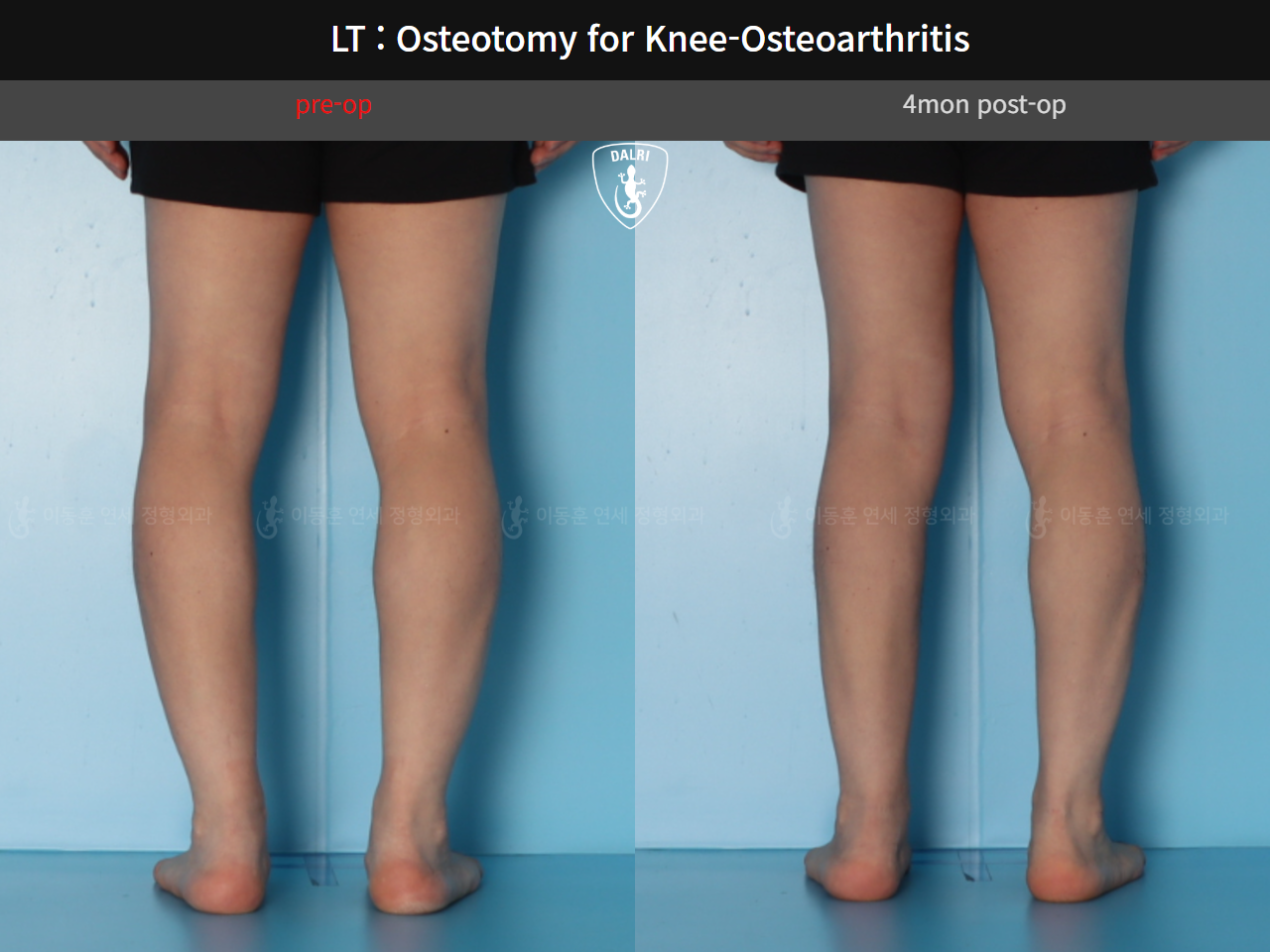 Before and after osteotomy for knee osteoarthritis, case 128374850, image 10, Dr. Donghoon institute (DALRI)
