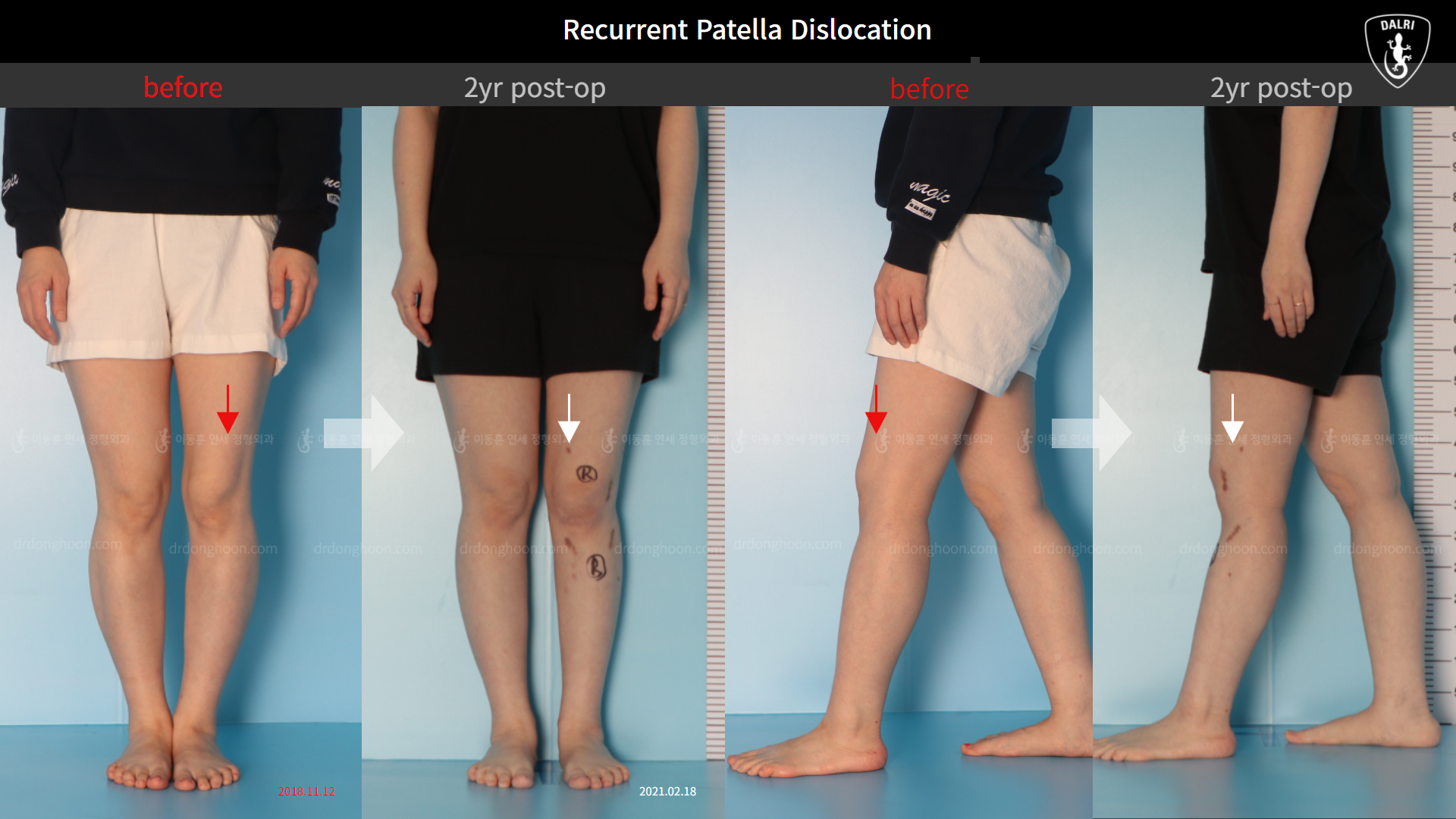 Before and after recurrent patella dislocation, case 10329296, image 3, Dr. Donghoon institute (DALRI)