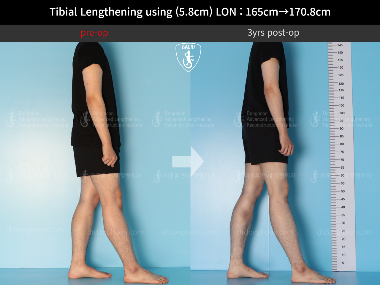Before and after cll lon, case 12828098, image 4, Dr. Donghoon institute (DALRI)