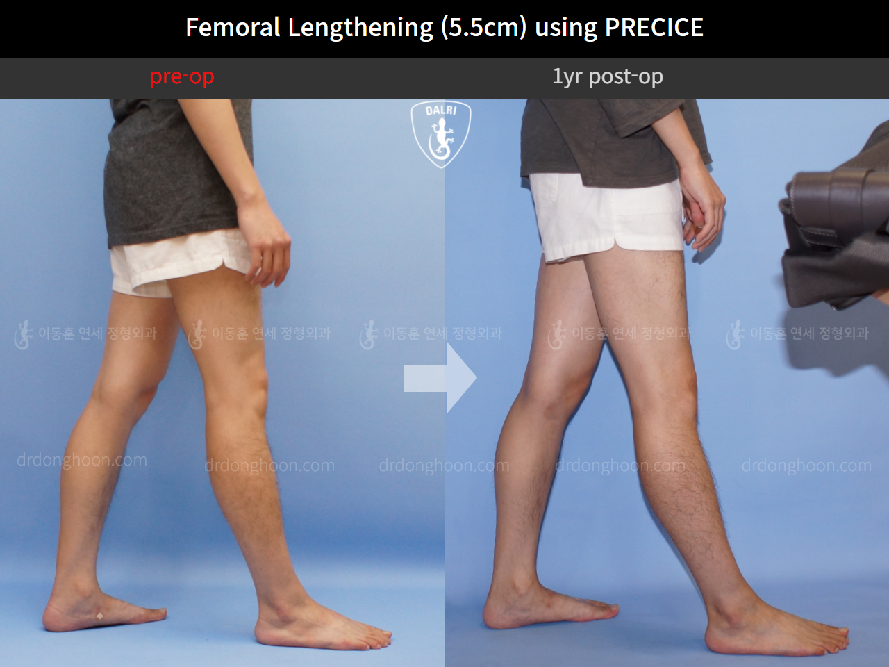 Before and after cll precice, case 4323383, image 8, Dr. Donghoon institute (DALRI)