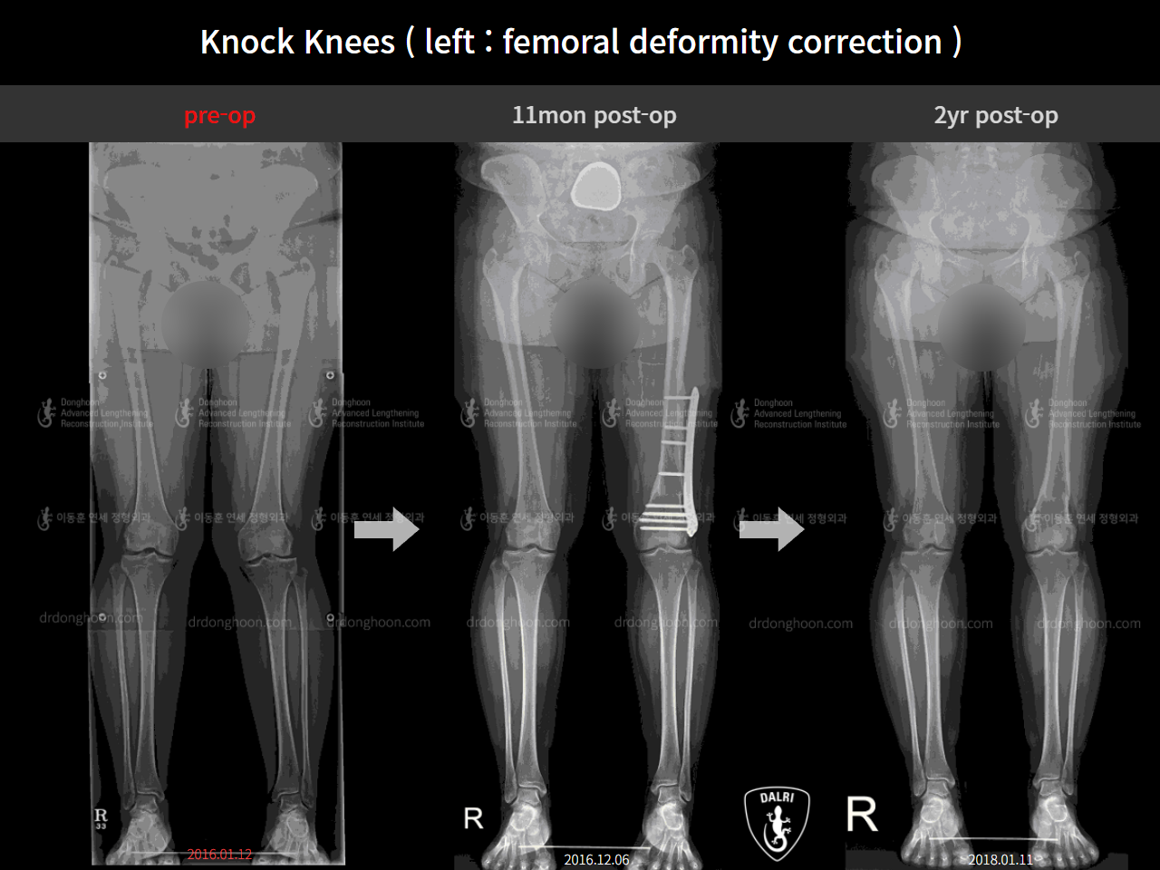 Before and after adult knock knees, case 9135984, image 1, Dr. Donghoon institute (DALRI)