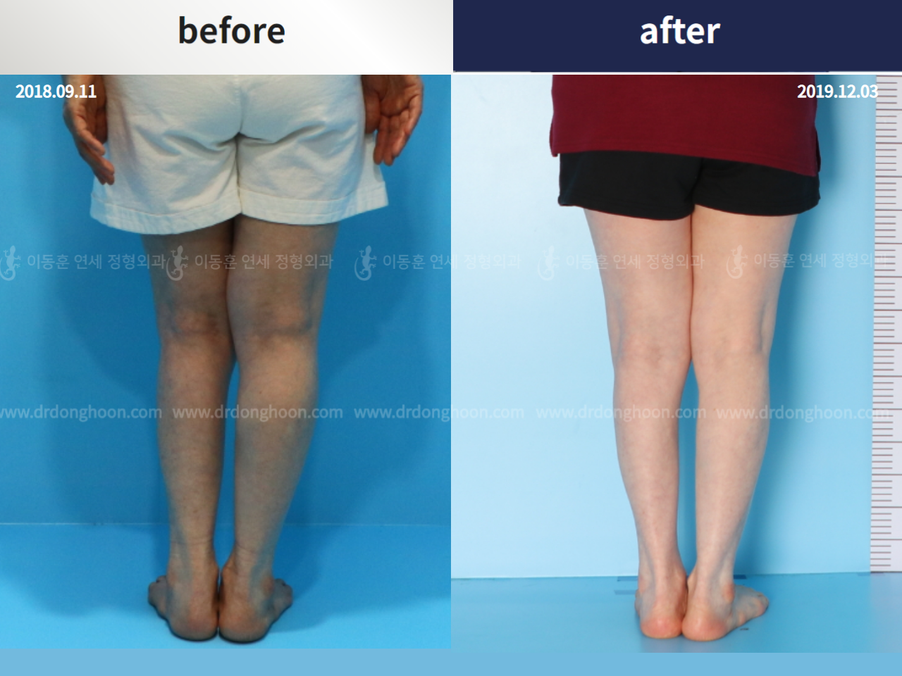 Before and after flexion deformity, case 4251739, image 3, Dr. Donghoon institute (DALRI)