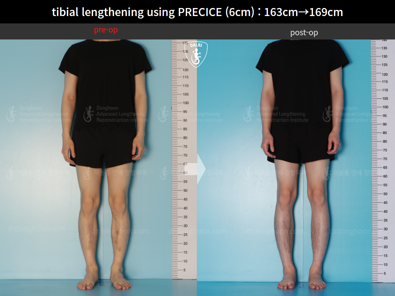 Before and after cll precice, case 16061529, image 2, Dr. Donghoon institute (DALRI)