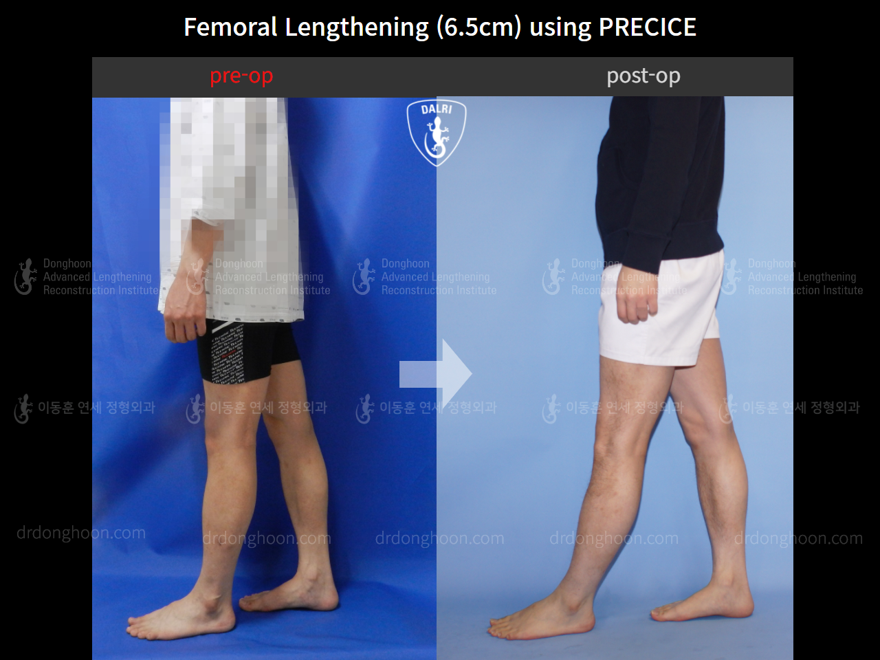 Before and after cll precice, case 4323401, image 4, Dr. Donghoon institute (DALRI)
