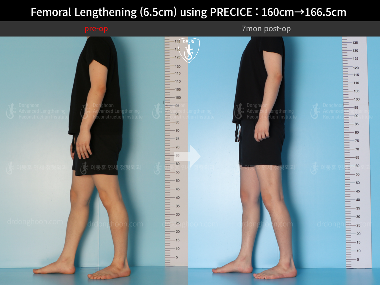 Before and after cll precice, case 13413485, image 4, Dr. Donghoon institute (DALRI)