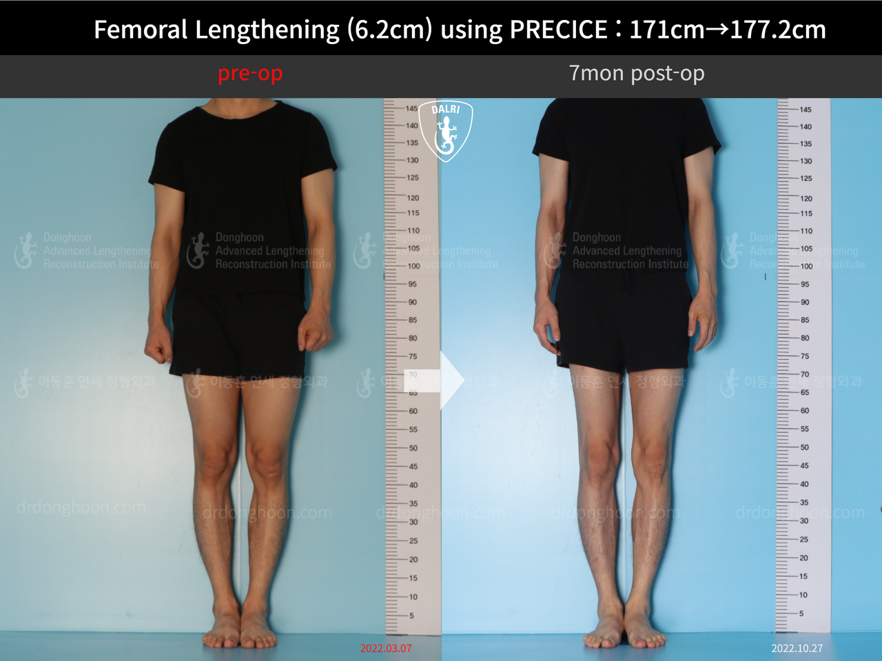 Before and after cll precice, case 13325833, image 1, Dr. Donghoon institute (DALRI)