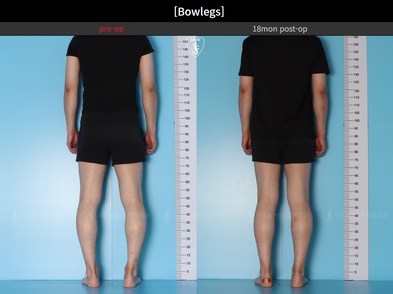 Before and after adult bowlegs, case 94769040, image 7, Dr. Donghoon institute (DALRI)