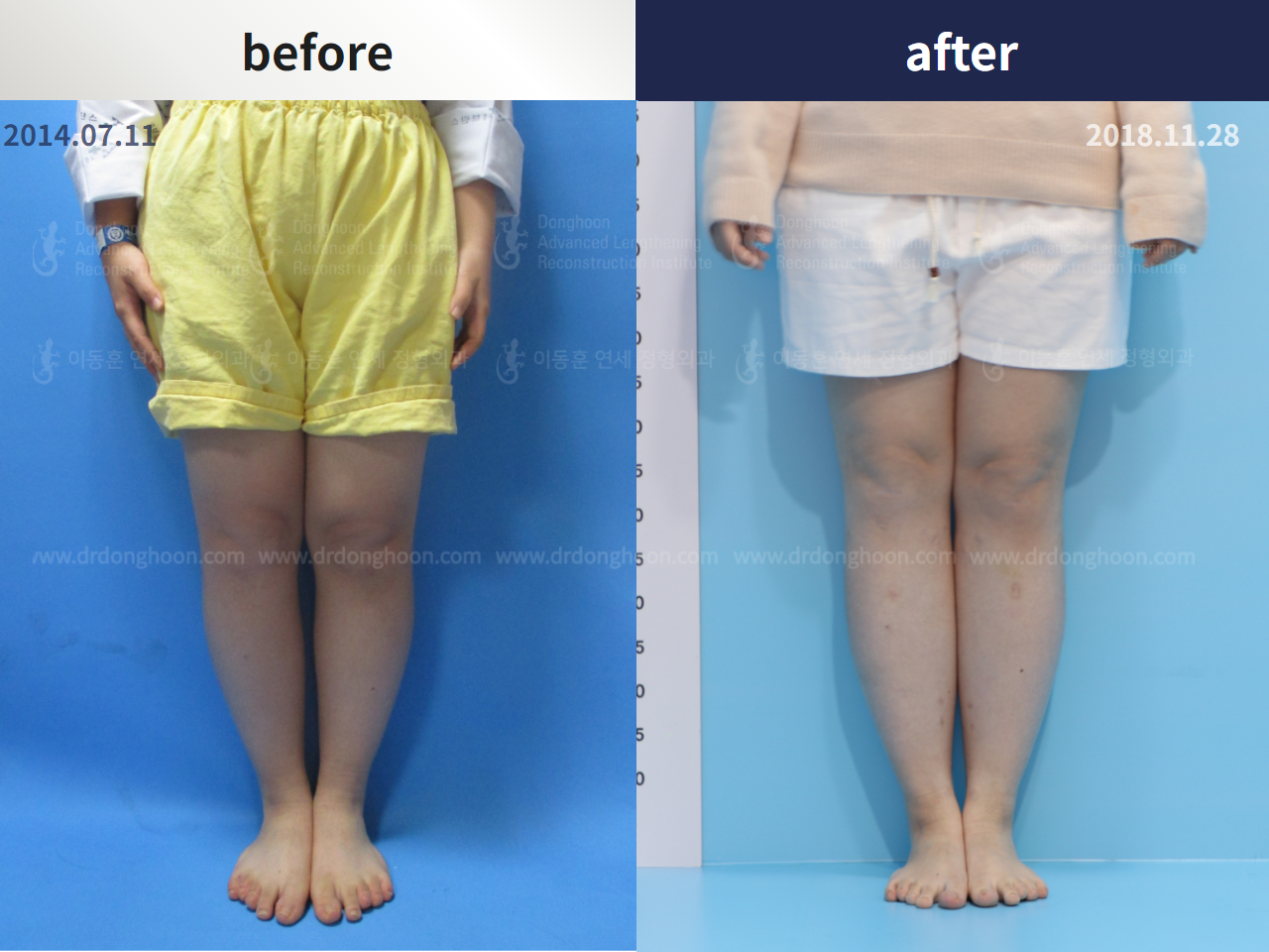 Before and after congenital condition, case 4300052, image 1, Dr. Donghoon institute (DALRI)